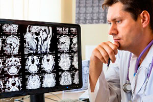 Инсульт: пять опасных заблуждений