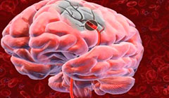 Лакунарный инфаркт мозга