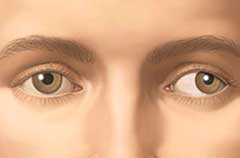 Косоглазие после инсульта