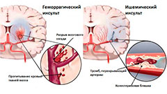 Ишемический инсульт