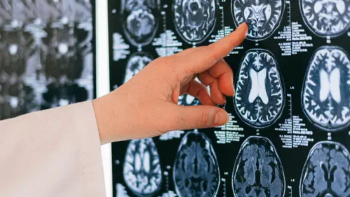 Ученые выявили способ предсказать инсульт за 10 лет до первого приступа 