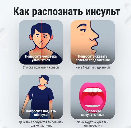 Как распознать инсульт: признаки, профилактика. Инфографика